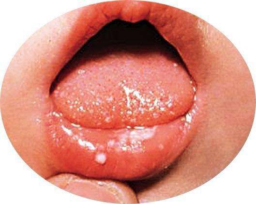 口腔溃疡与HPV，并非直接相关