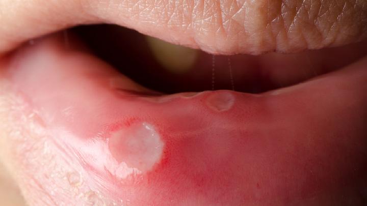 口腔溃疡与HPV，并非直接相关