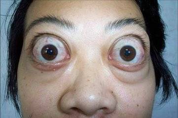 甲亢得上还有完全治愈的可能吗？全面解读与希望之光