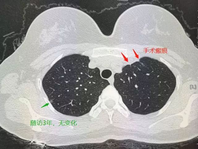 警惕！27岁女子肺结节疏忽致肺癌，年轻不是护身符