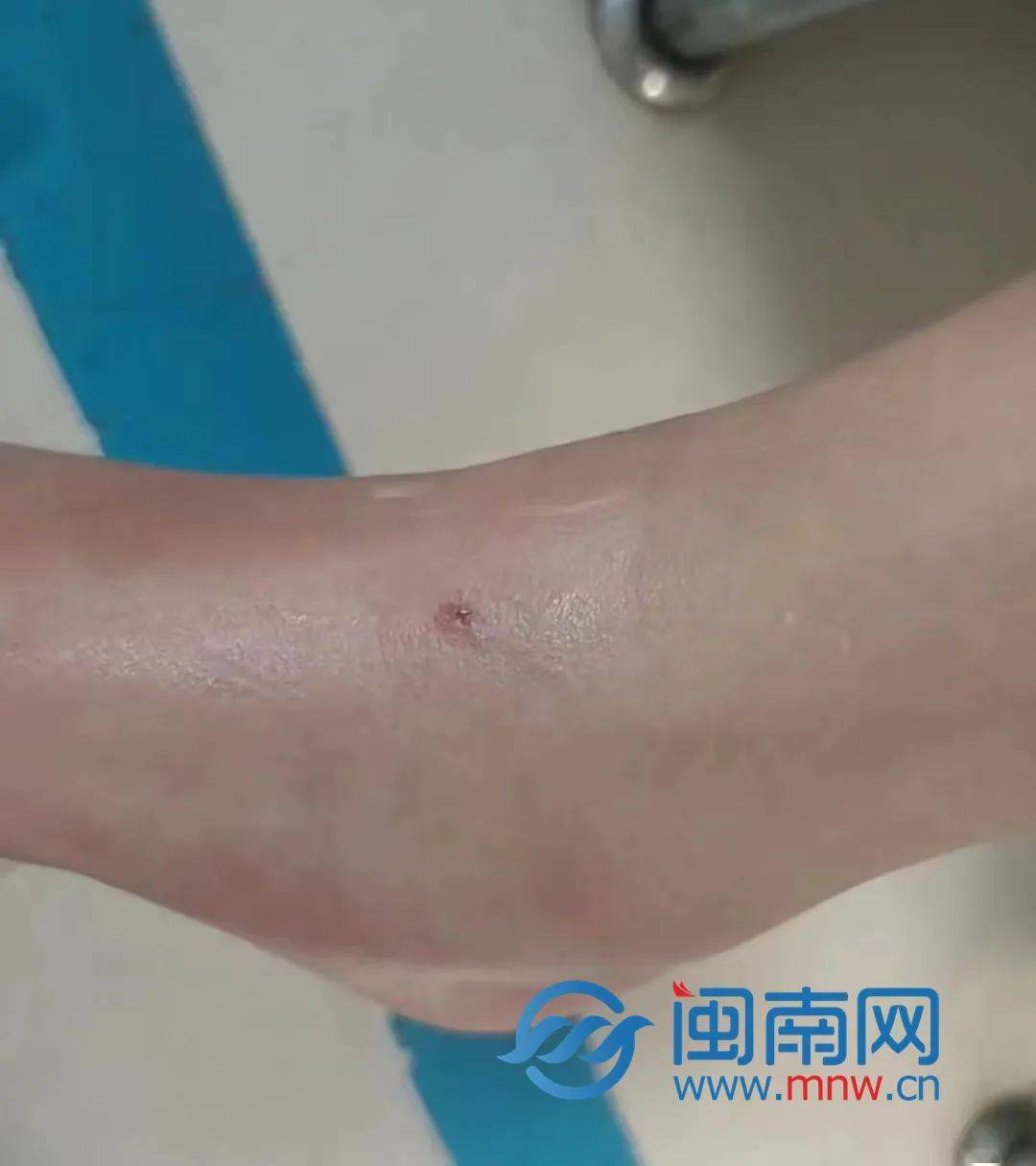 女子旅游遭遇蛇咬伤事件全解析