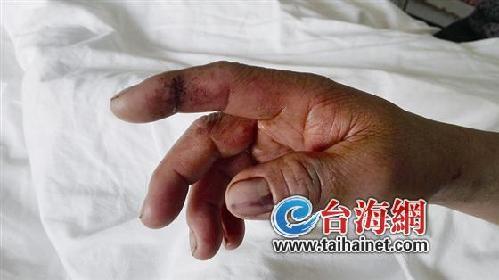 海南悲剧，被蛇咬伤中毒身亡的背后
