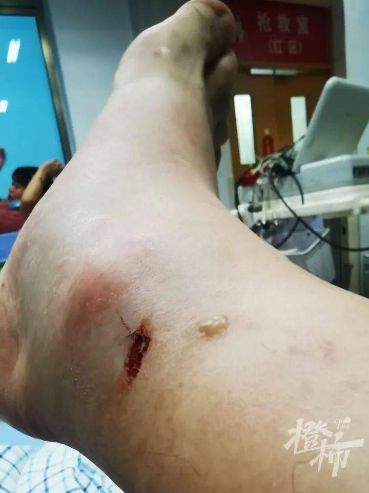 三亚遭遇蛇咬惊魂记