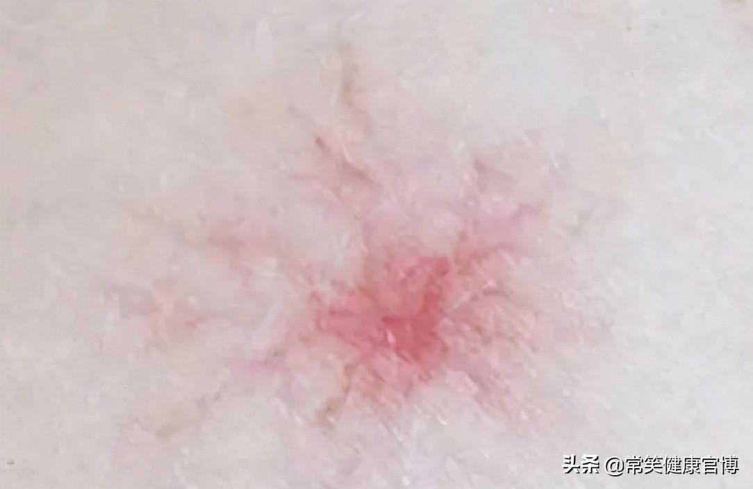 孕期肝癌的表现