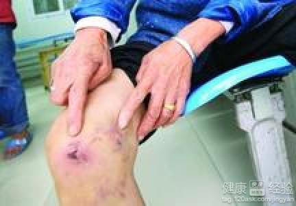 男子被狗咬伤后未就医，三个月后悲剧离世