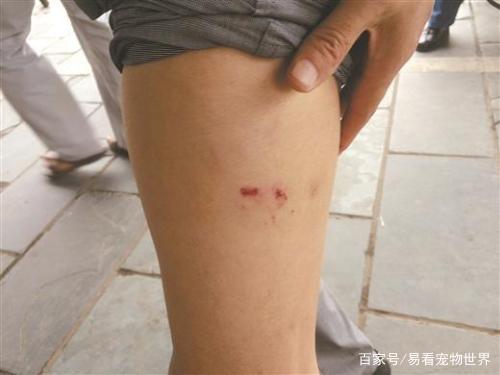 狗咬人三个月后未死，是否排除感染风险？