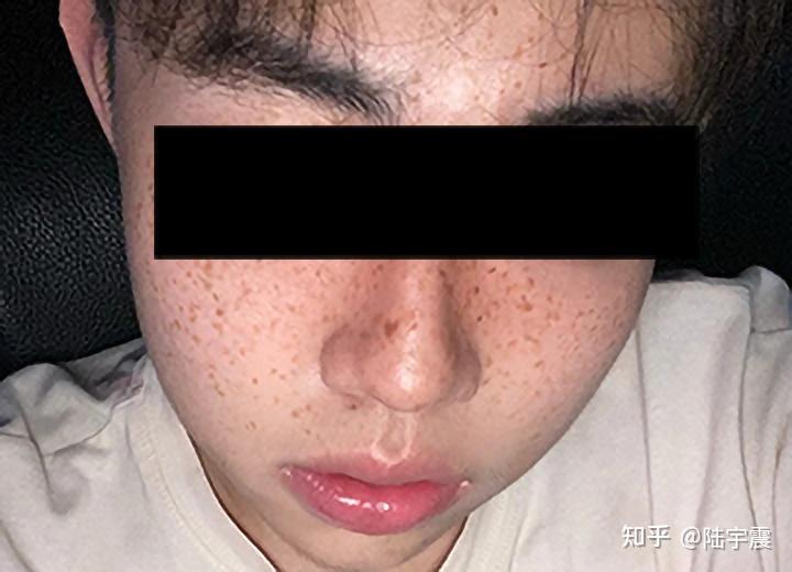 自学打水光长硬疙瘩——我的护肤心得分享