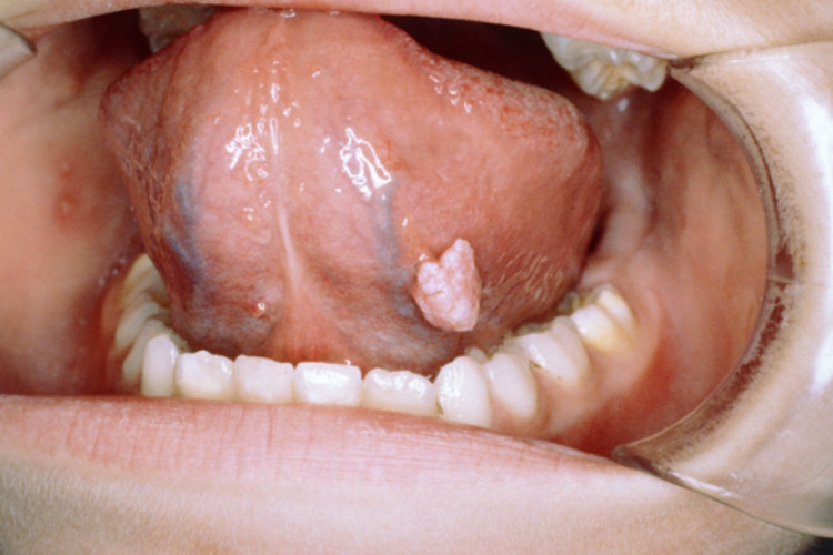 口腔溃疡与HPV，并非同一概念