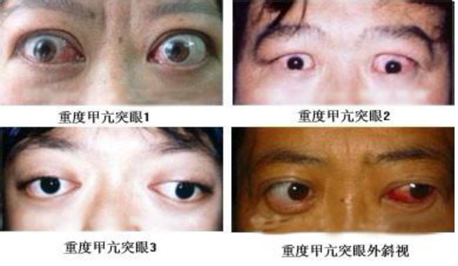 甲亢沿海地区，疾病现状、影响因素与防治策略