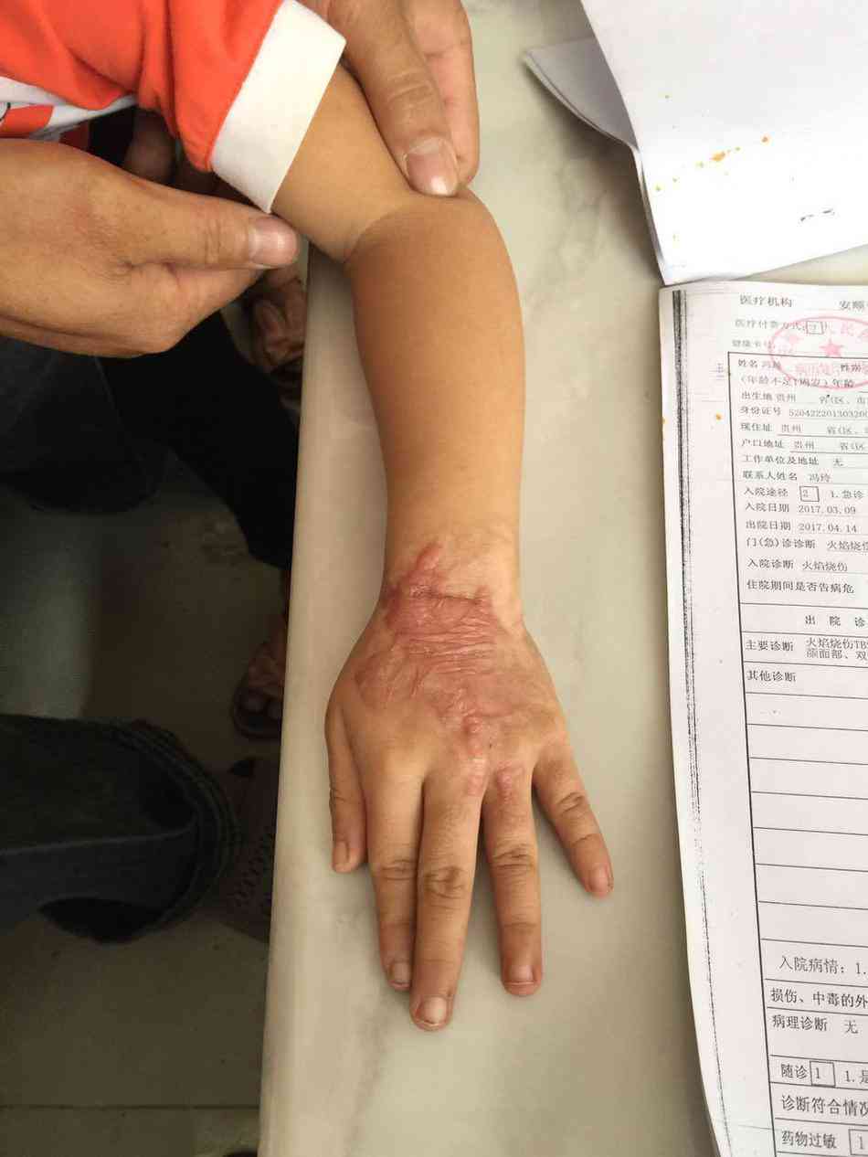 员工上班冲奶粉烫伤被认定工伤，工伤认定的深度解读与社会关注