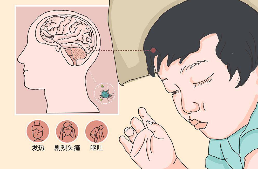女子吃冷冻肉后头疼欲裂，确诊脑膜炎——警惕食品安全与健康风险